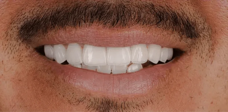 The same patient's smile after treatment at Central Washington Dental Care