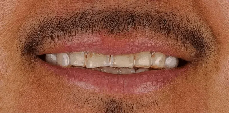 Patient smile before treatment at Central Washington Dental Care