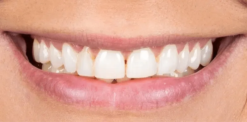 The same smile before treatment